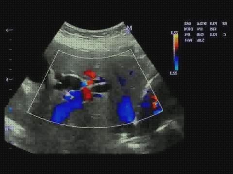 Review de ecografía y hernia hiatal