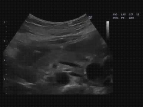 Las 6 Mejores Ecografías Y Hernias Hiatal