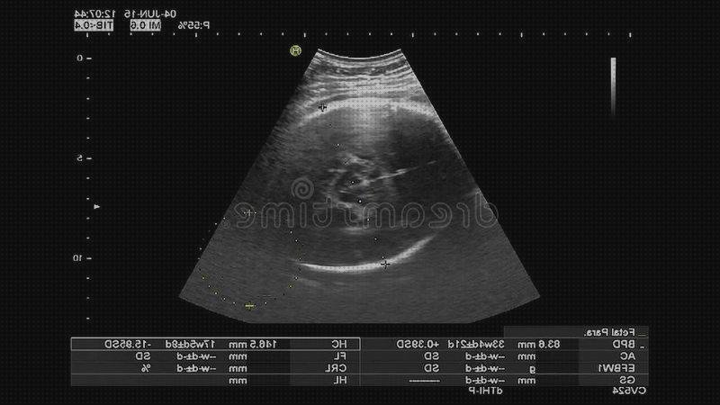 Review de ecografías bebe latido corazon