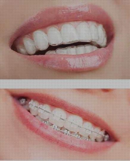 Las mejores marcas de brackets ecografías con brackets