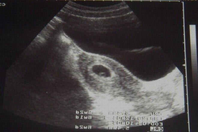 Review de ecografías de embarazo de 6 semanas