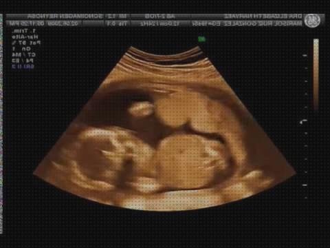 Las mejores 14 Ecografías De Niñas 4 Meses
