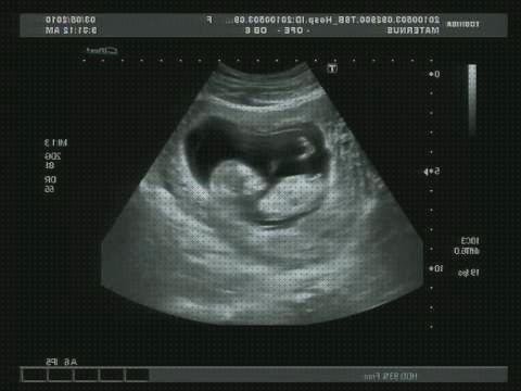 Review de ecografías de niña 4 meses