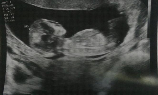 Las mejores ecografías por semanas Mas ecografía coneja ecografías ecografías de niña de 12 semanas de perfil