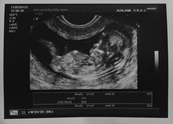 Las 12 Mejores Ecografías De Niñas De 12 Semanas De Perfiles