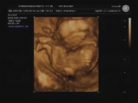 Las mejores marcas de meses ecografías de niña 4 meses