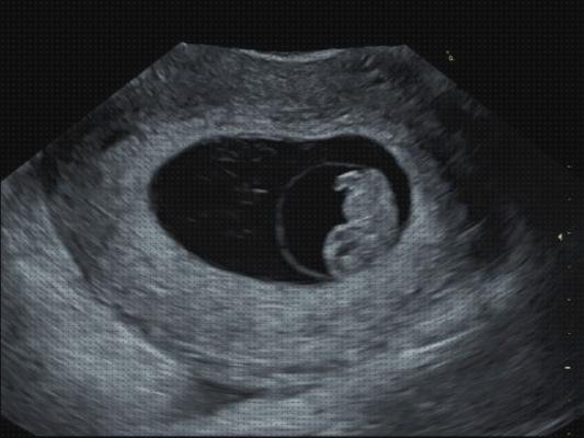 Las mejores marcas de semanas ecografía embarazada de 8 semanas