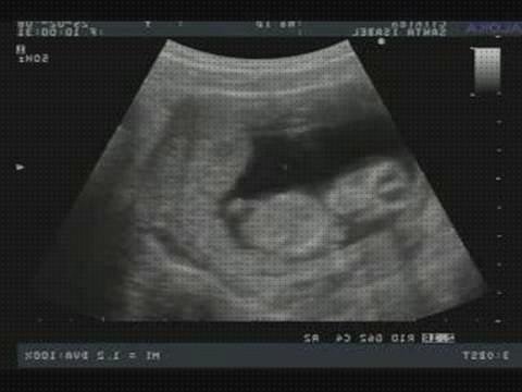 Las mejores marcas de meses ecografía feto tres meses