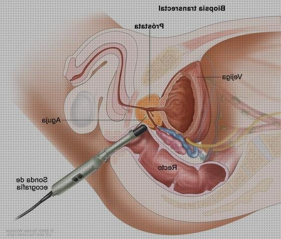 Las mejores cancer ecografía transrectal cancer recto