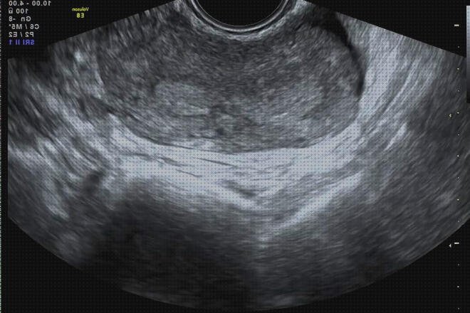 ¿Dónde poder comprar transvaginal ecografía transvaginal tvus?