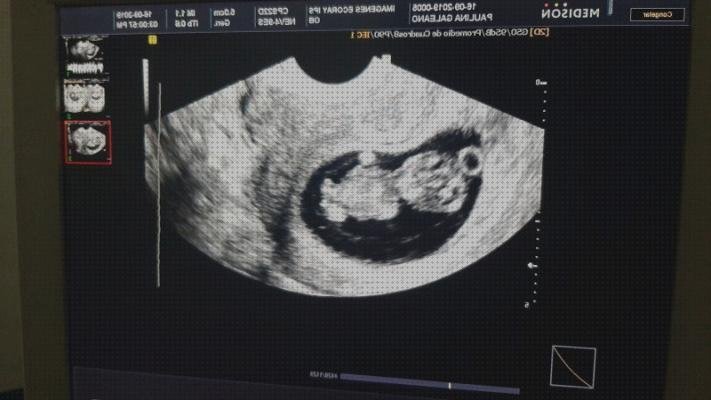 Review de ecografías vaginales meses de embarazo