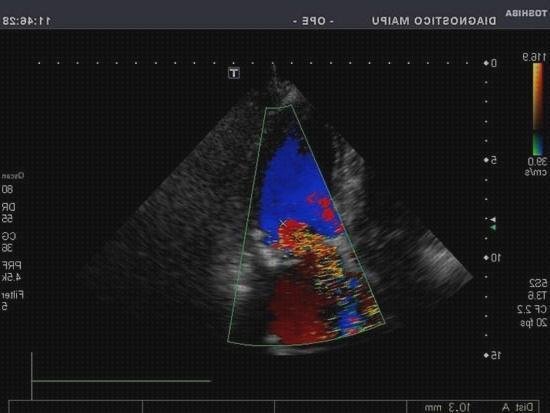 Las mejores marcas de corazon doppler eco doppler color corazon