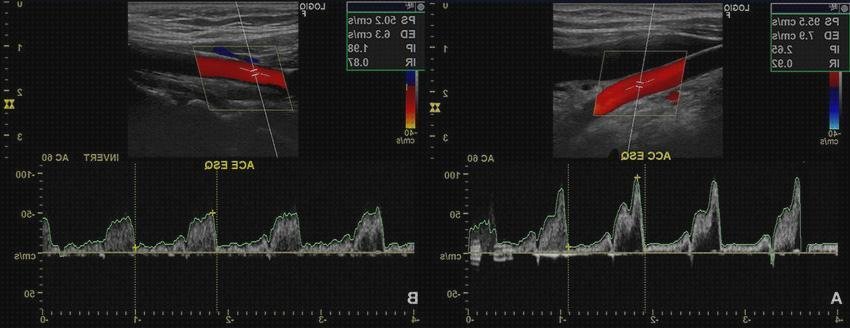 Las mejores doppler eco doppler de carotidas