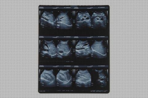 Los 5 Mejores Los Cancer Se Detecta Con Unas Ecografías Abdominales