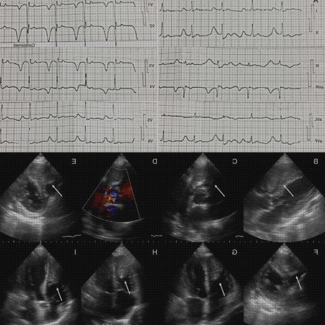 Las mejores electrocardiograma electrocardiograma y ecografía