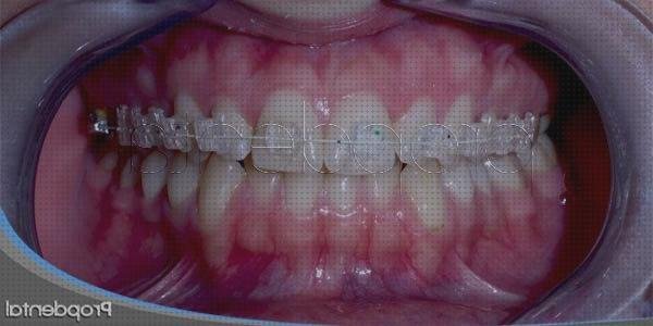 Las mejores encias encias inflamadas porr el irrigador dental