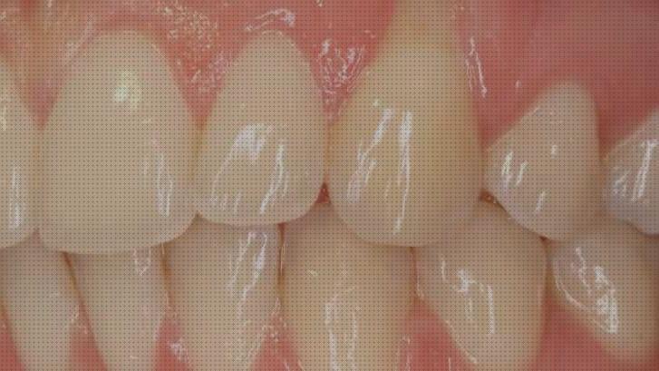 Review de encias inflamadas porr el irrigador dental