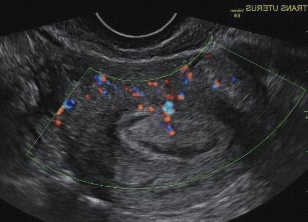 ¿Dónde poder comprar endometrial?
