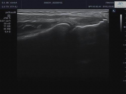 Las mejores marcas de epicondilitis epicondilitis lateral ecografía