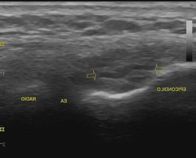 Las mejores epicondilitis epicondilitis lateral ecografía