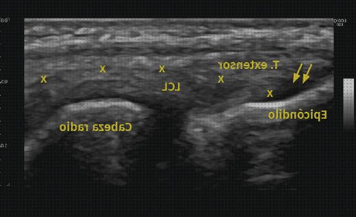 Review de epicondilitis lateral ecografía