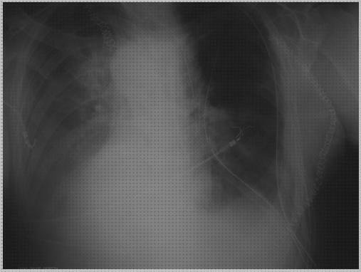 Las mejores espirometro para mediastino