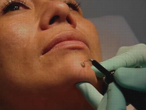 ¿Dónde poder comprar verrugas bisturi extracción verrugas bisturi electrico?