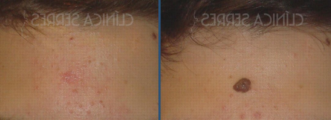 Review de extracción verrugas bisturi electrico