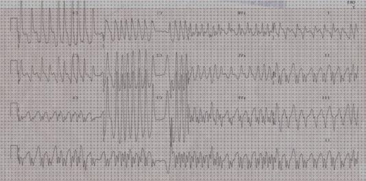 ¿Dónde poder comprar diagnostico fibrilacion auricular diagnostico electrocardiografico?
