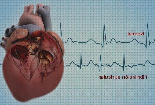 Las mejores diagnostico fibrilacion auricular diagnostico electrocardiografico