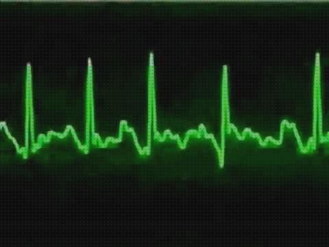 Opiniones de los 11 mejores Fibrilacion Auriculares Diagnostico Electrocardiografico