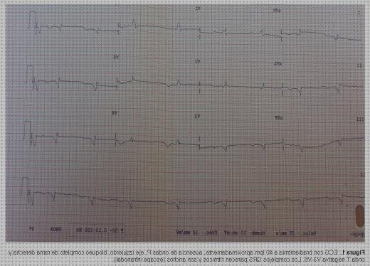 Las mejores electrocardiograficos fibrilacion auricular signos electrocardiograficos