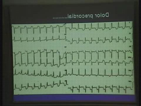 ¿Dónde poder comprar electrocardiograficos fibrilacion auricular signos electrocardiograficos?