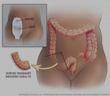 Los 8 Mejores Fonendoscopia Cancer De Cólones