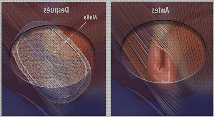 Opiniones de las 7 mejores Hernias Povidona Yodada Y Cubrir Con Apósitos