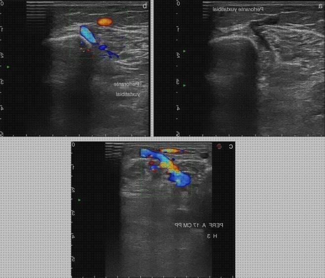 20 Mejores ecos doppler insuficiencias