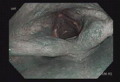 Los mejores 3 Laringoscopia Con Narrow Band