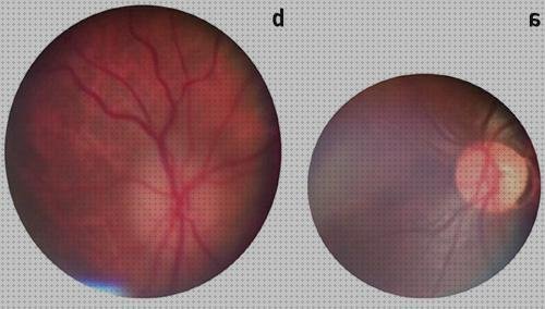 Review de lente de oftalmoscopia indirecta 28 d