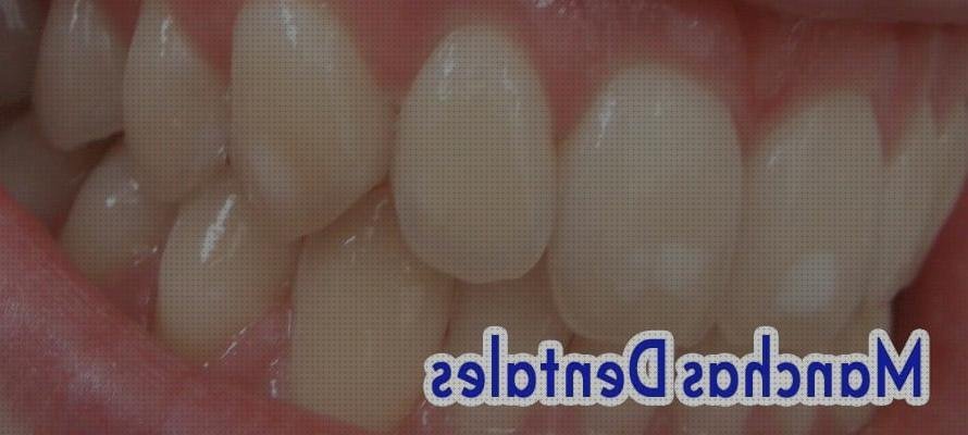 Los 13 Mejores Los Irrigadores Dentales Quitan Las Manchas De Los Dientes