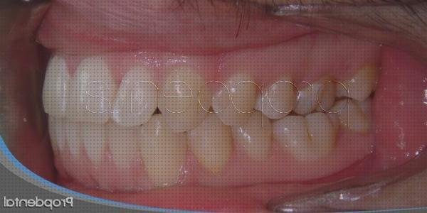 Review de los irrigadores dentales quitan las manchas de los dientes