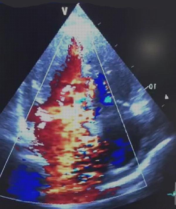 23 Mejores mitral médicos