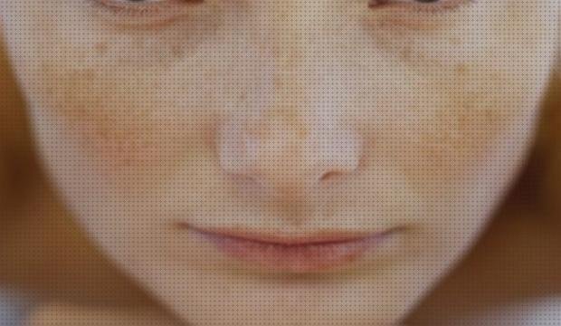 Review de los 13 mejores nevus médicos del mundo