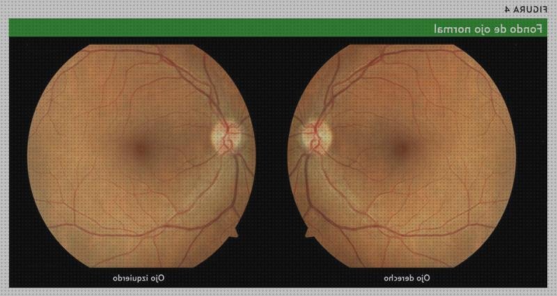 Las mejores numeros oftalmoscopio numeros