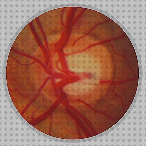 ¿Dónde poder comprar oftalmoscopios oftalmoscopio portátil?
