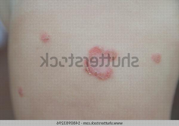 Análisis de los 13 mejores Picores Y Pelar Pieles Vendas