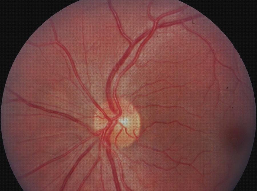 Opiniones de oftalmoscopia lampara hendidura reflejo oscuro en oftalmoscopia directa oftalmoscopia