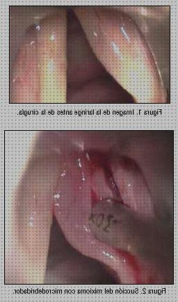 ¿Dónde poder comprar reinke laringoscopia laringoscopia edema reinke?