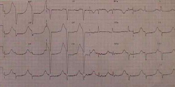 ¿Dónde poder comprar electrocardiograficos signos electrocardiograficos de cardiopatia isquemica?