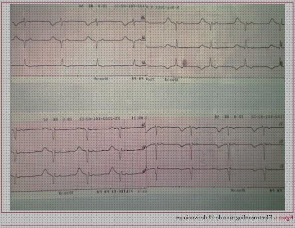 Los mejores 4 Signos Electrocardiograficos De Pericarditis Aguda