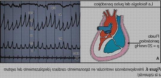 Los 4 Mejores Signos Electrocardiograficos De Taponamiento Cardiacos
